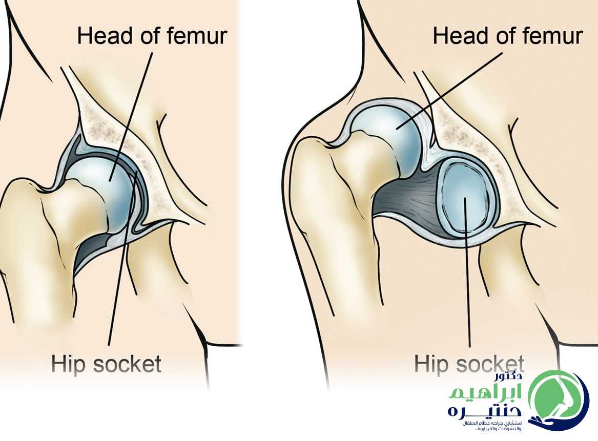 علاج خلع مفصل الحوض عند الأطفال