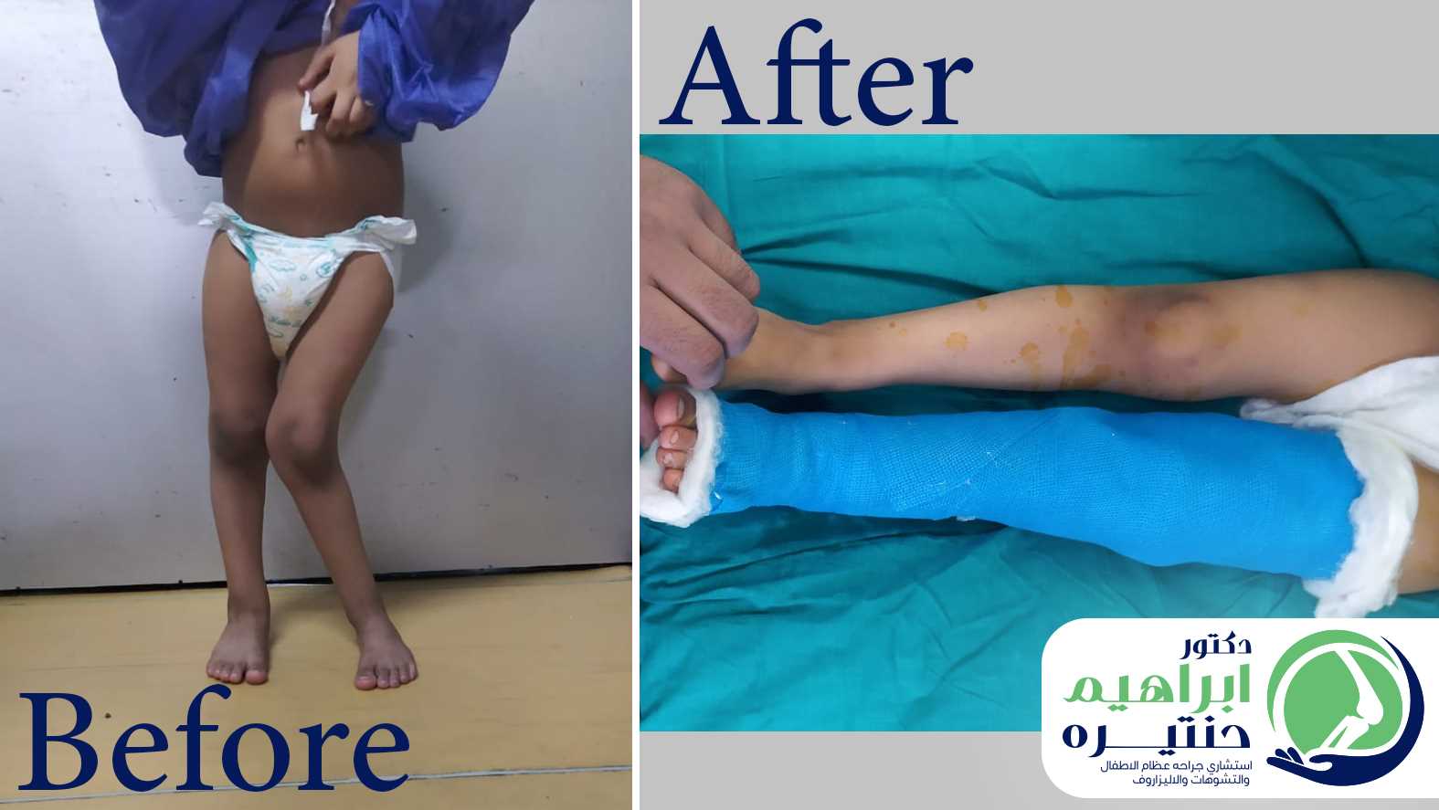 علاج التصاق الفخذين وتشوه مفصل الركبة